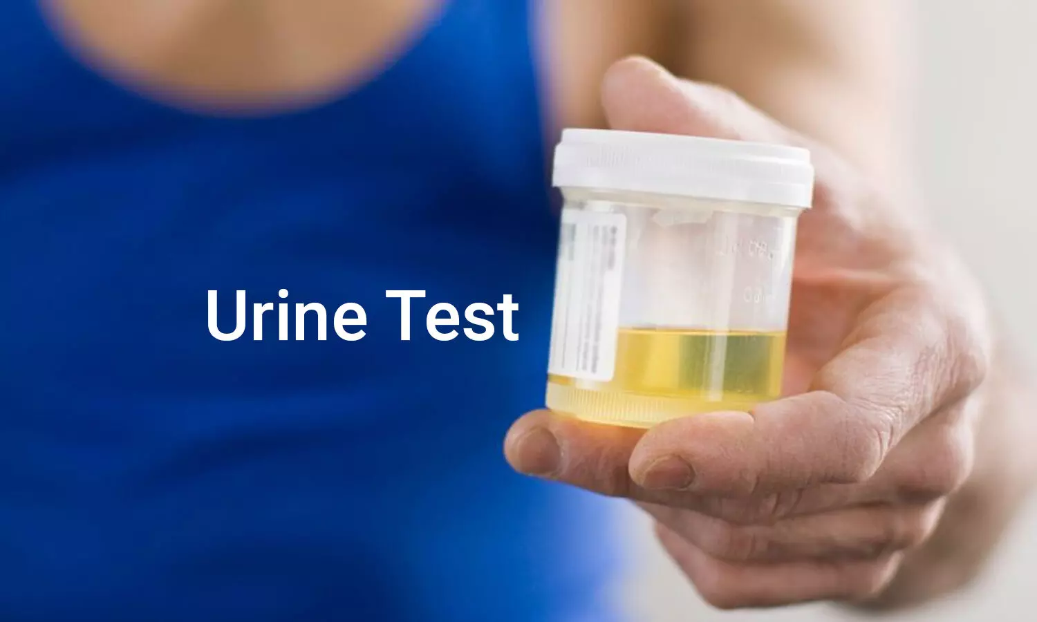 Prostate cancer urine test identifies good prognosis patients