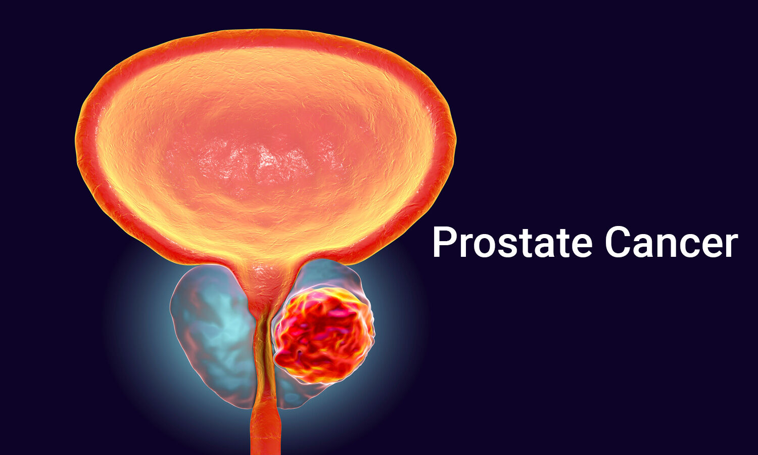 new research in prostate cancer