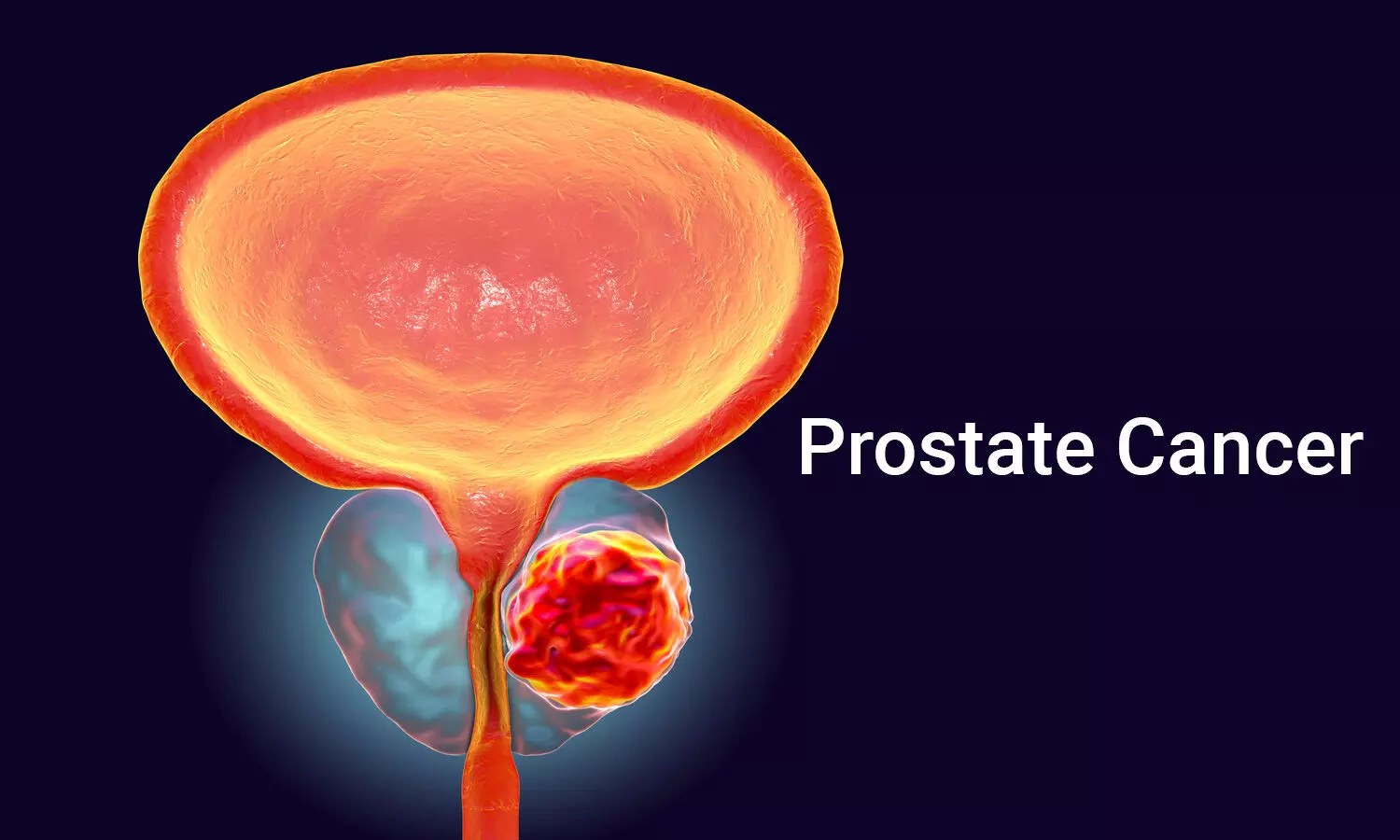 Being overweight in middle age increases prostate cancer risk