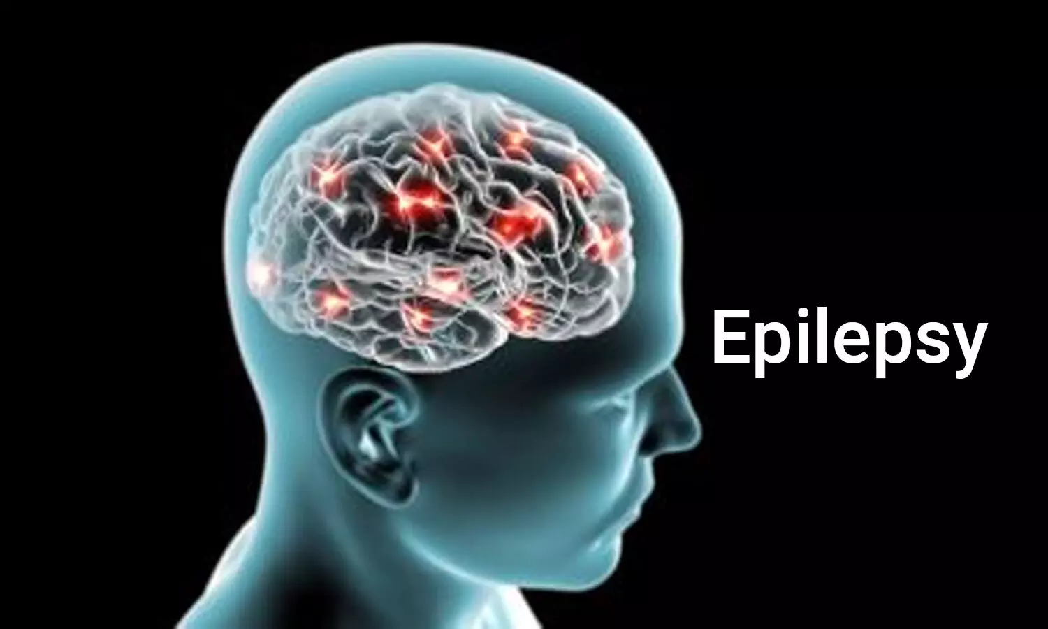 Hypertension may double risk of developing epilepsy