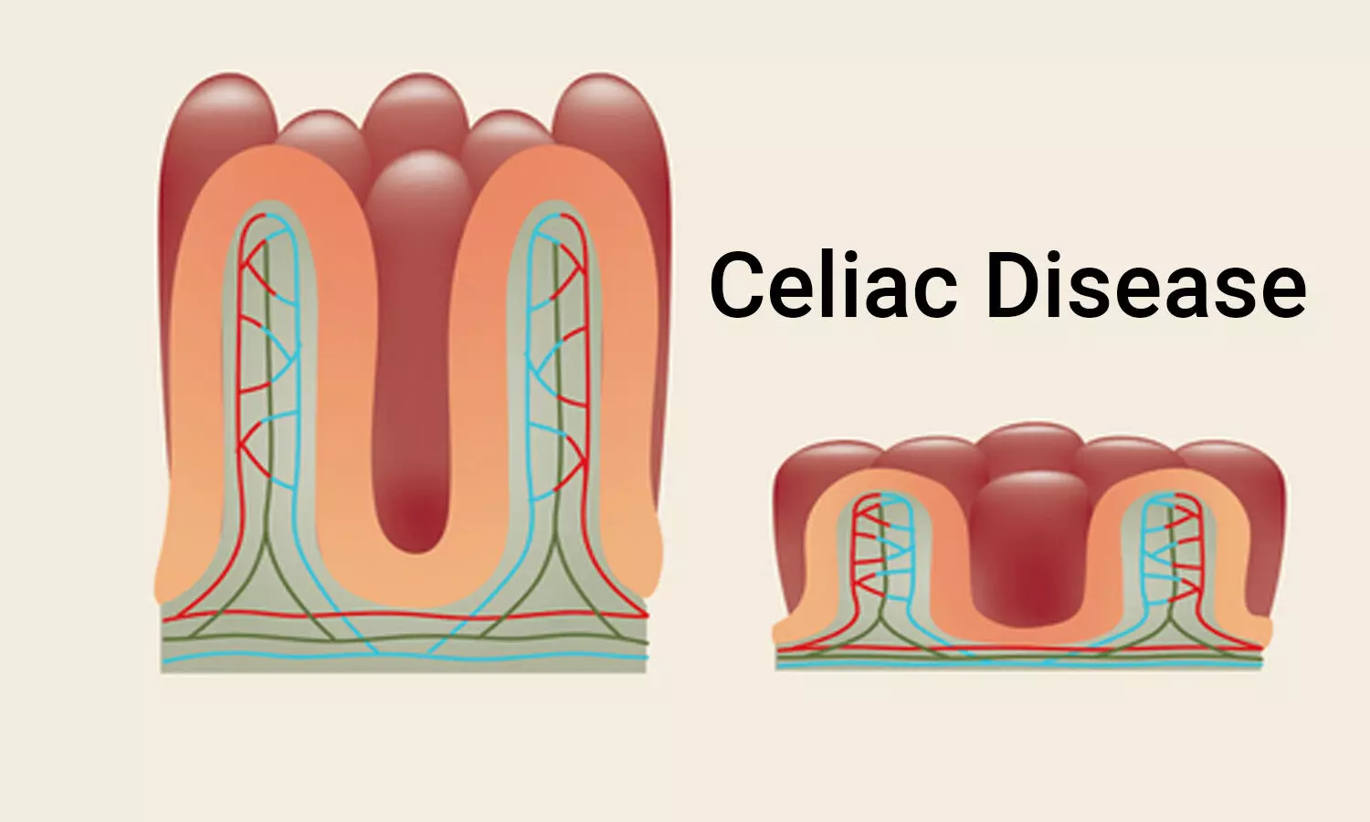 Celiac disease associated with Sexual dysfunction in males as well