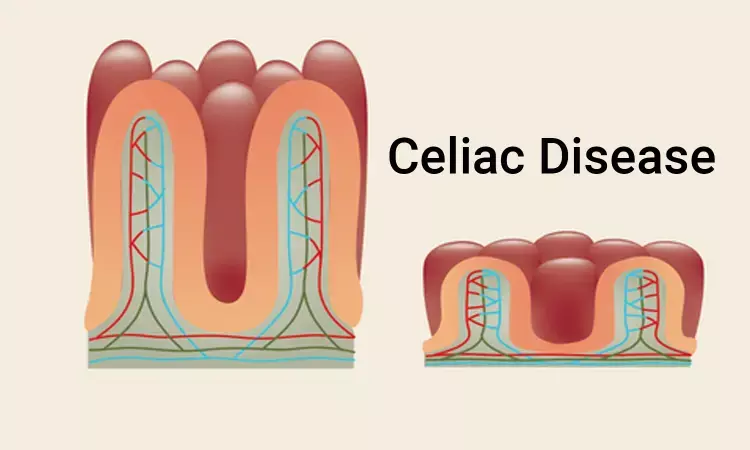 Celiac disease associated with  Sexual dysfunction in males as well as females: Study