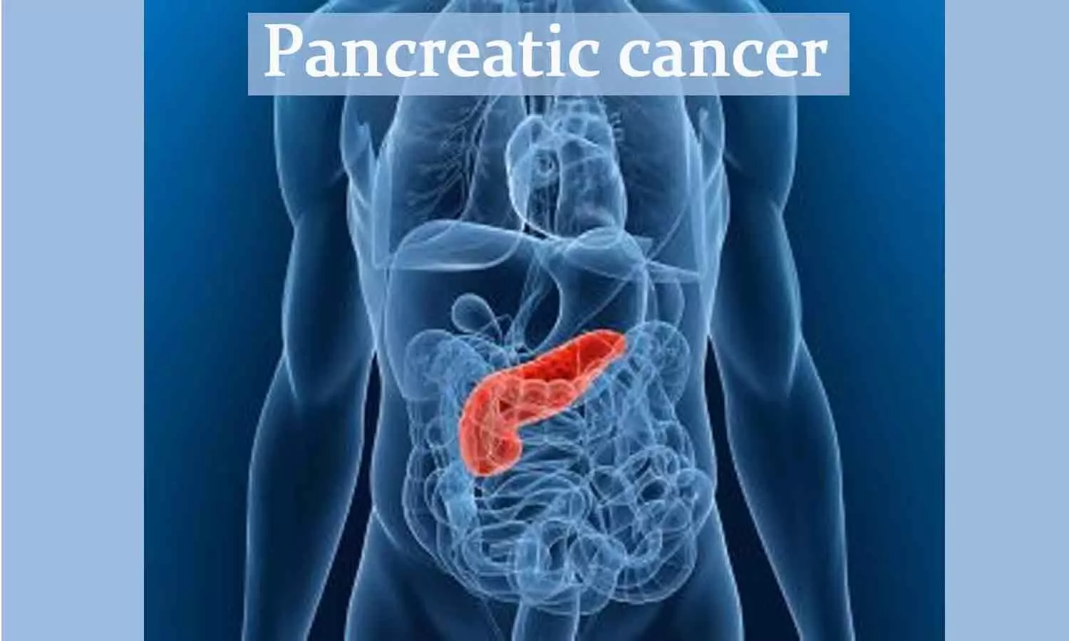 High fasting blood sugar tied to development of pancreatic cancer: Study