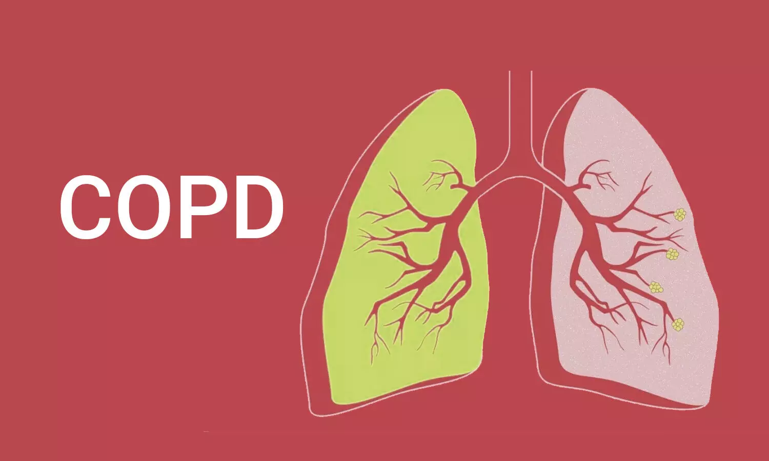 COPD patients at higher risk for future functional gastrointestinal disorders: Study