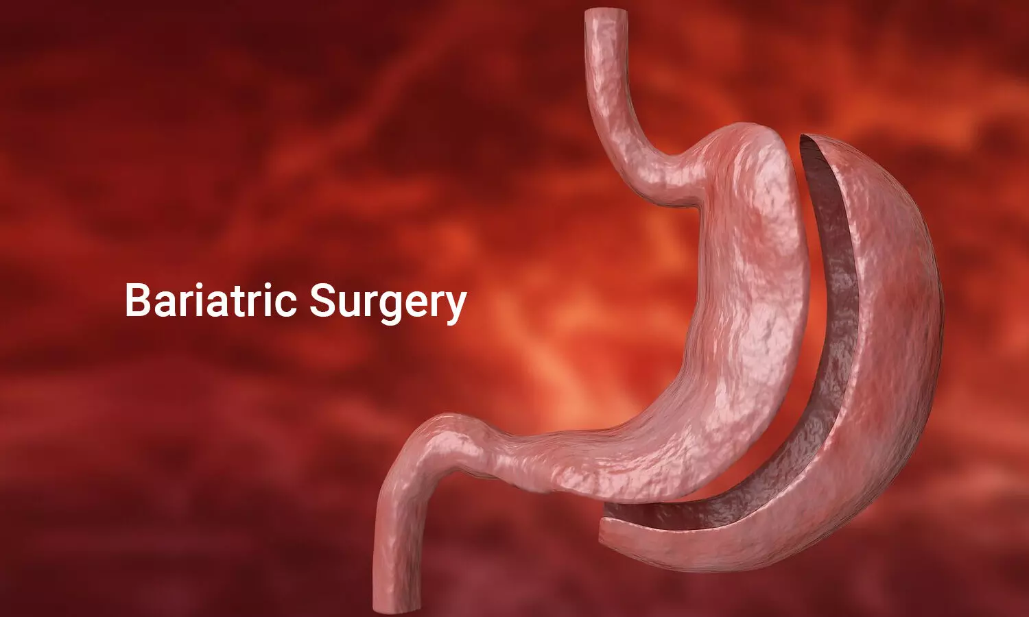 Bariatric: Weight Loss surgery Details 