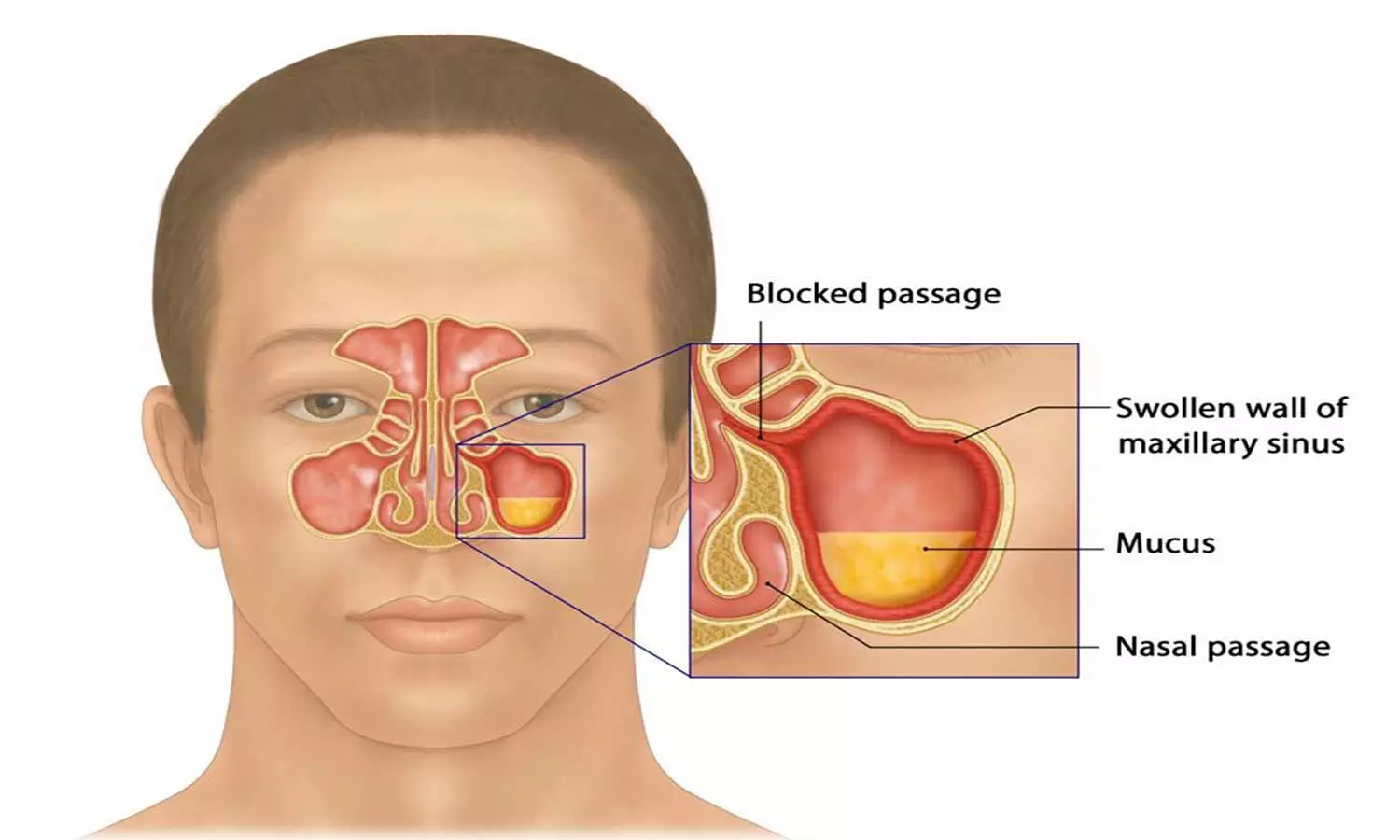 Fungal rhinosinusitis deals