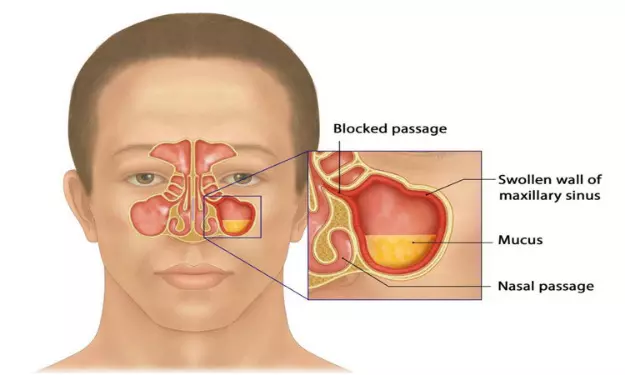 Bilateral nasal clearance polyps