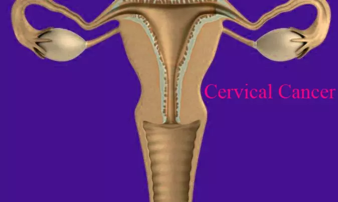 Copper IUDs better than hormonal IUDs in reducing cervical cancer risks