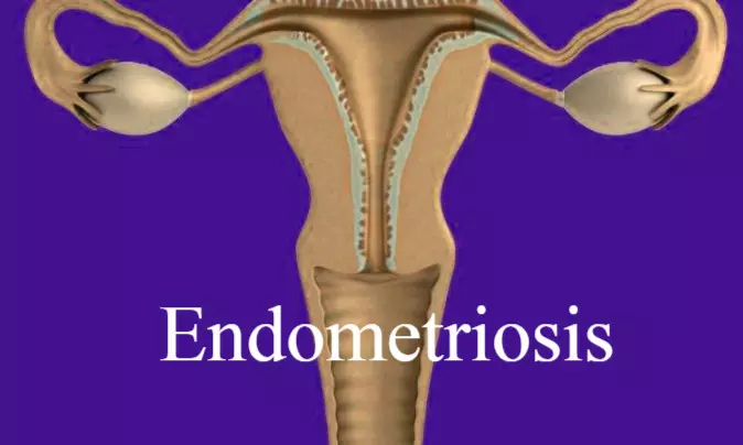 Tall and lean girls at greater risk of developing endometriosis finds study