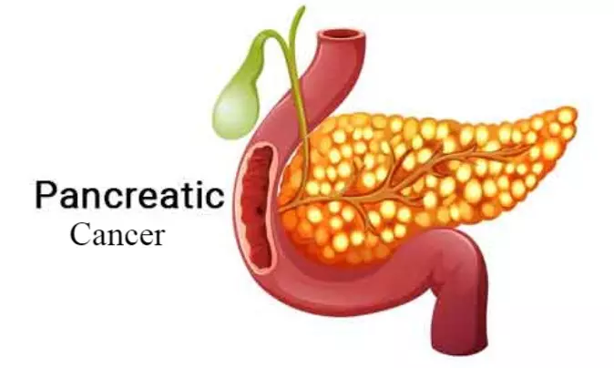 Sotorasib beneficial for certain pancreatic cancers: Study