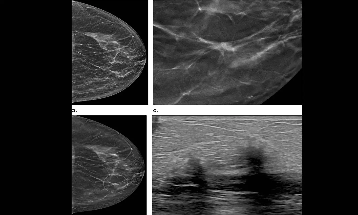 Tomosynthesis bests digital mammography in five-year study