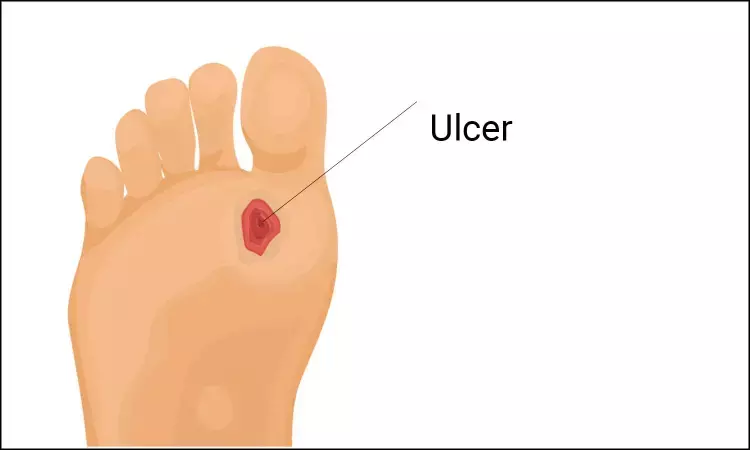 New temperature and pressure regulating soles prevent diabetic foot ulcers