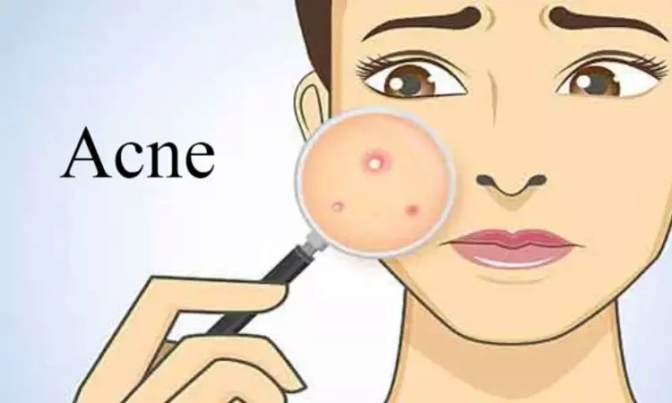 Trifarotene- The latest retinoid for acne management