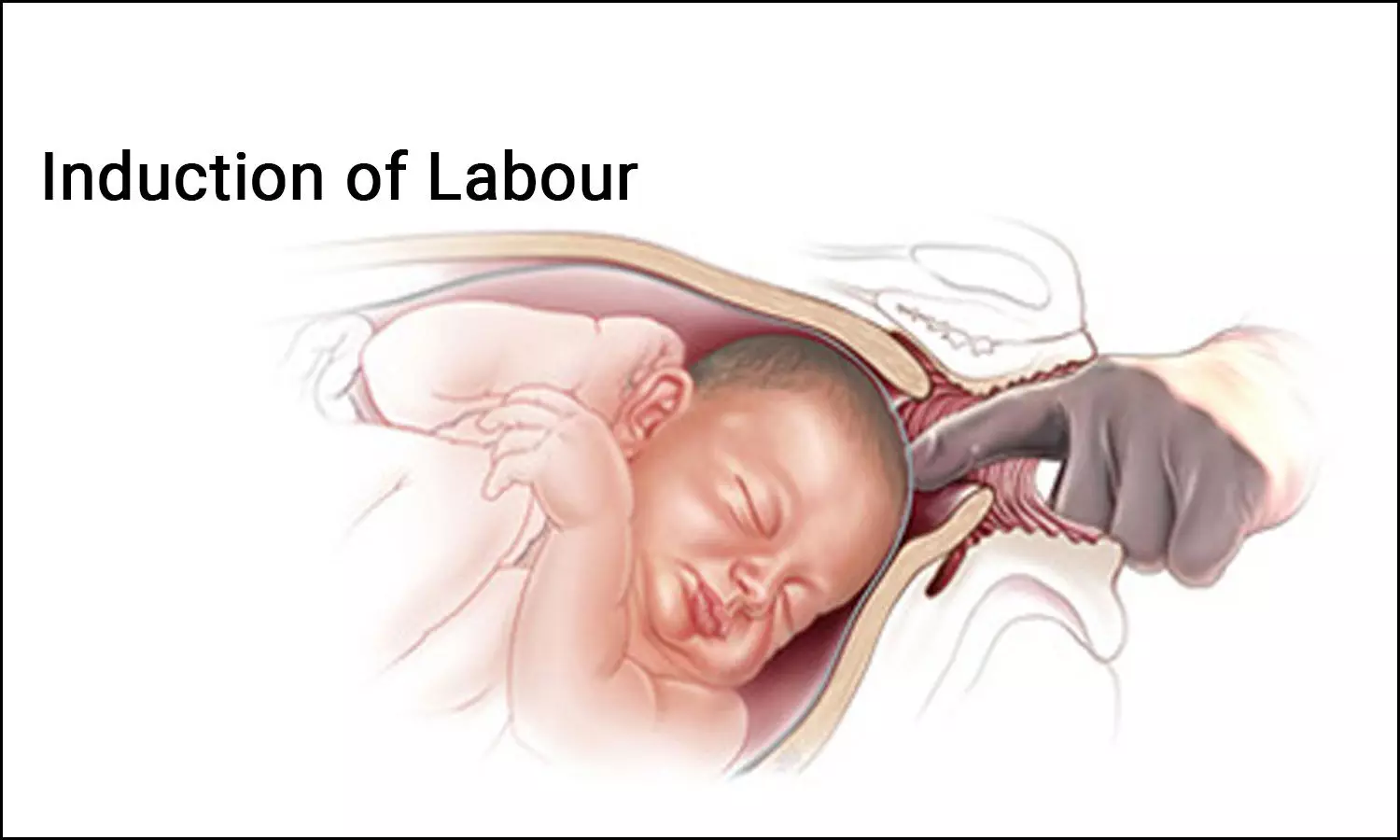 Is membrane sweeping a safe method for induction of labour?