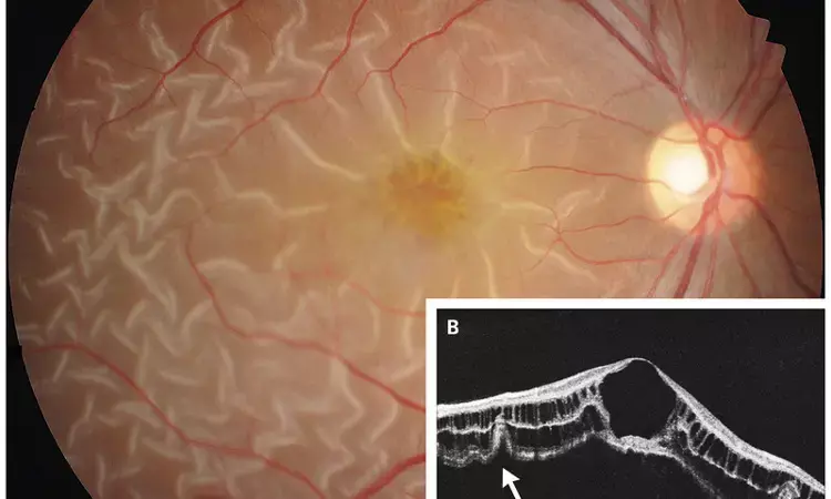 Rare case of X-Linked Retinoschisis presents as retinal detachment