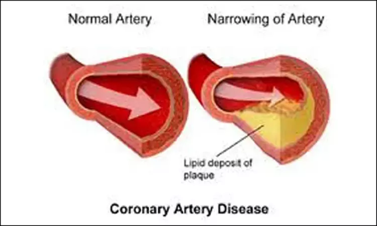 Low vaspin levels linked to increased coronary artery disease