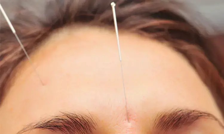 Acupuncture can reduce migraine headaches