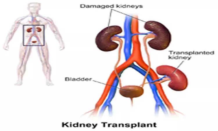 Renal Transplantation linked to improvement of anemia in CKD patients,finds study
