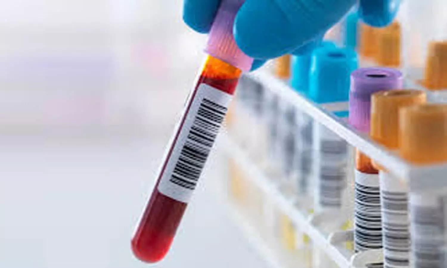 Blood test may help in early detection of pancreatic cancer