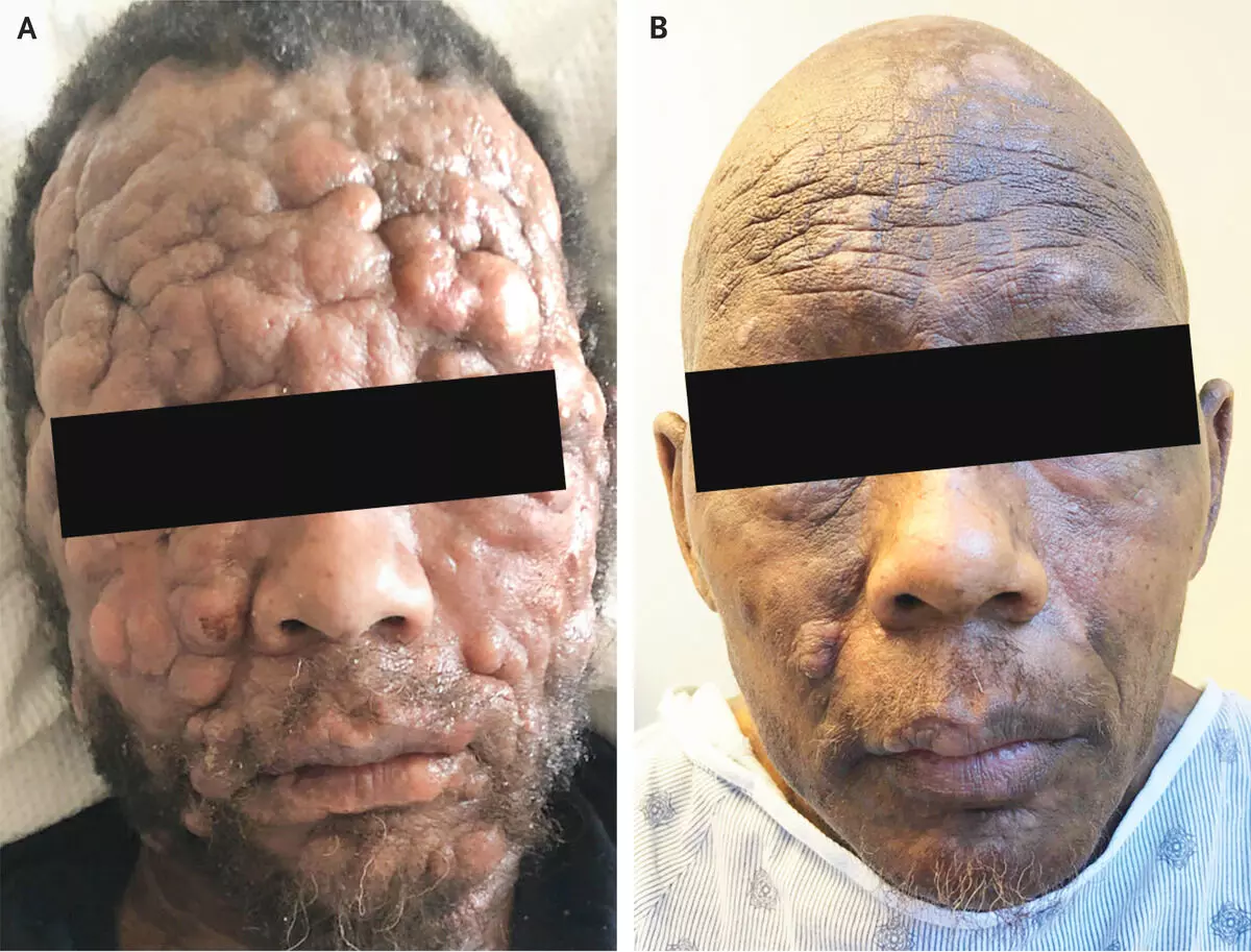 Case of advanced mycosis fungoides reported in NEJM