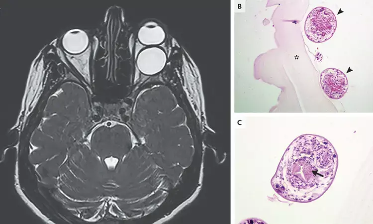 Rare case of Orbital hydatid cyst reported in NEJM