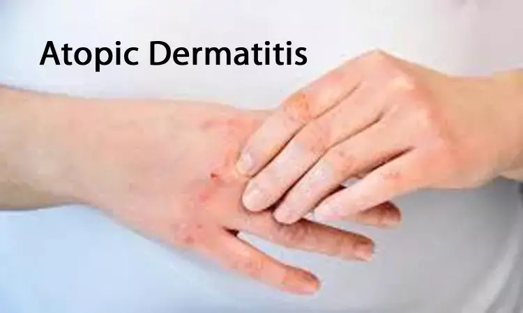 Subcutaneous nemolizumab improves itching in atopic dermatitis patients: NEJM