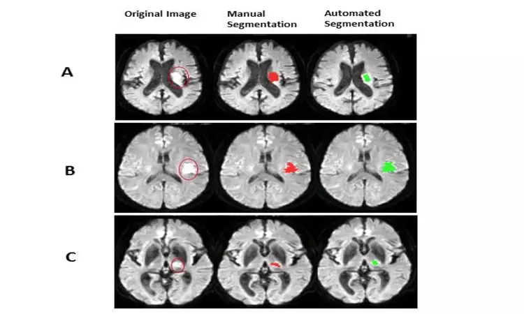 Artificial intelligence may help in faster detection of ischemic stroke