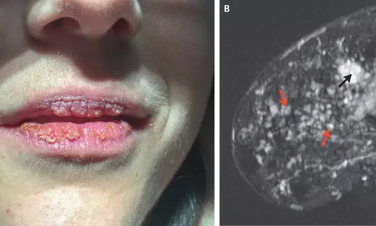 Rare case of Cowden syndrome reported in NEJM