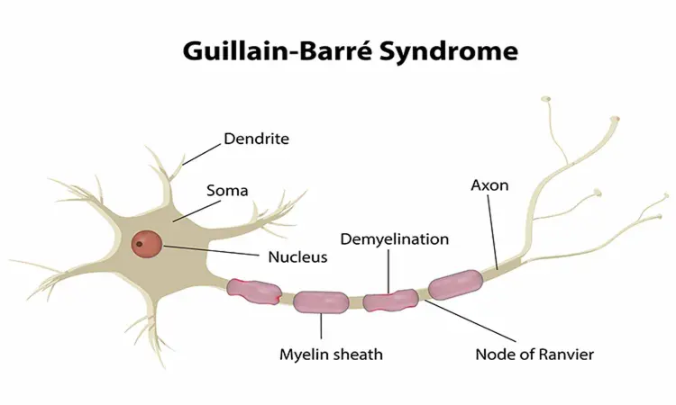 Study finds no significant association between COVID-19 and Guillain-Barre syndrome