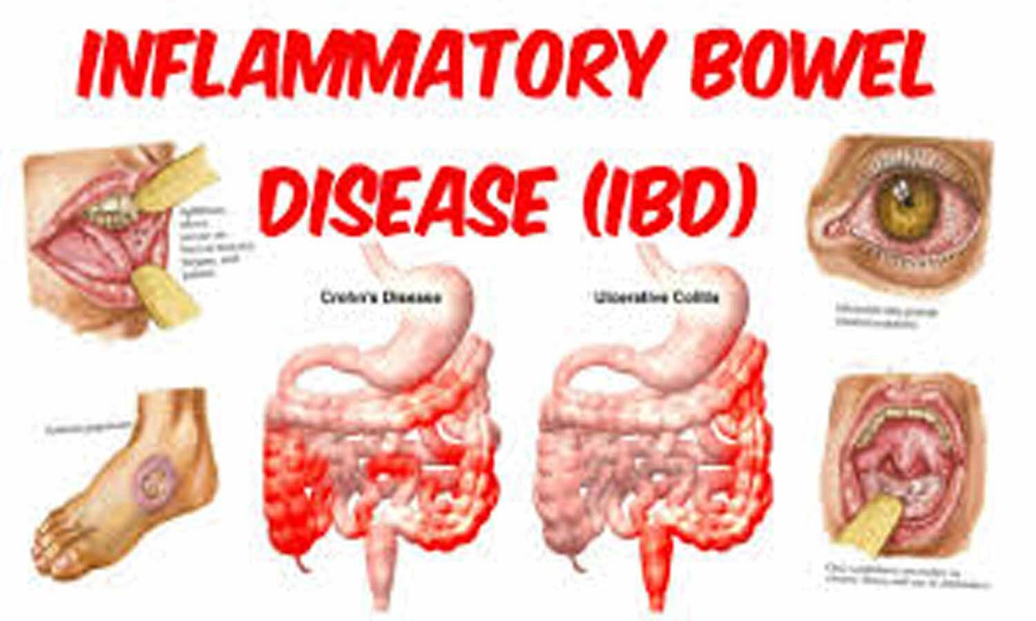 inflammatory-bowel-disease-linked-to-adverse-pregnancy-outcomes