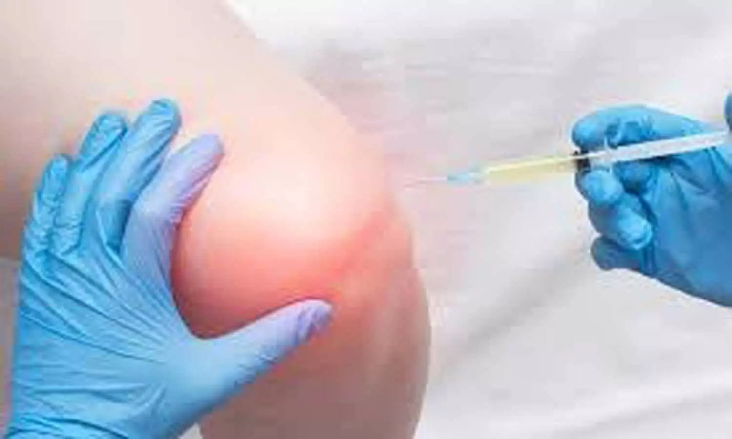 Physical Therapy bests Glucocorticoid Injection in Knee Osteoarthritis