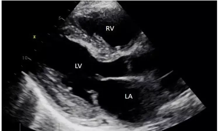 Levosimendan may improve right ventricular function in patients undergoing mitral valve surgery