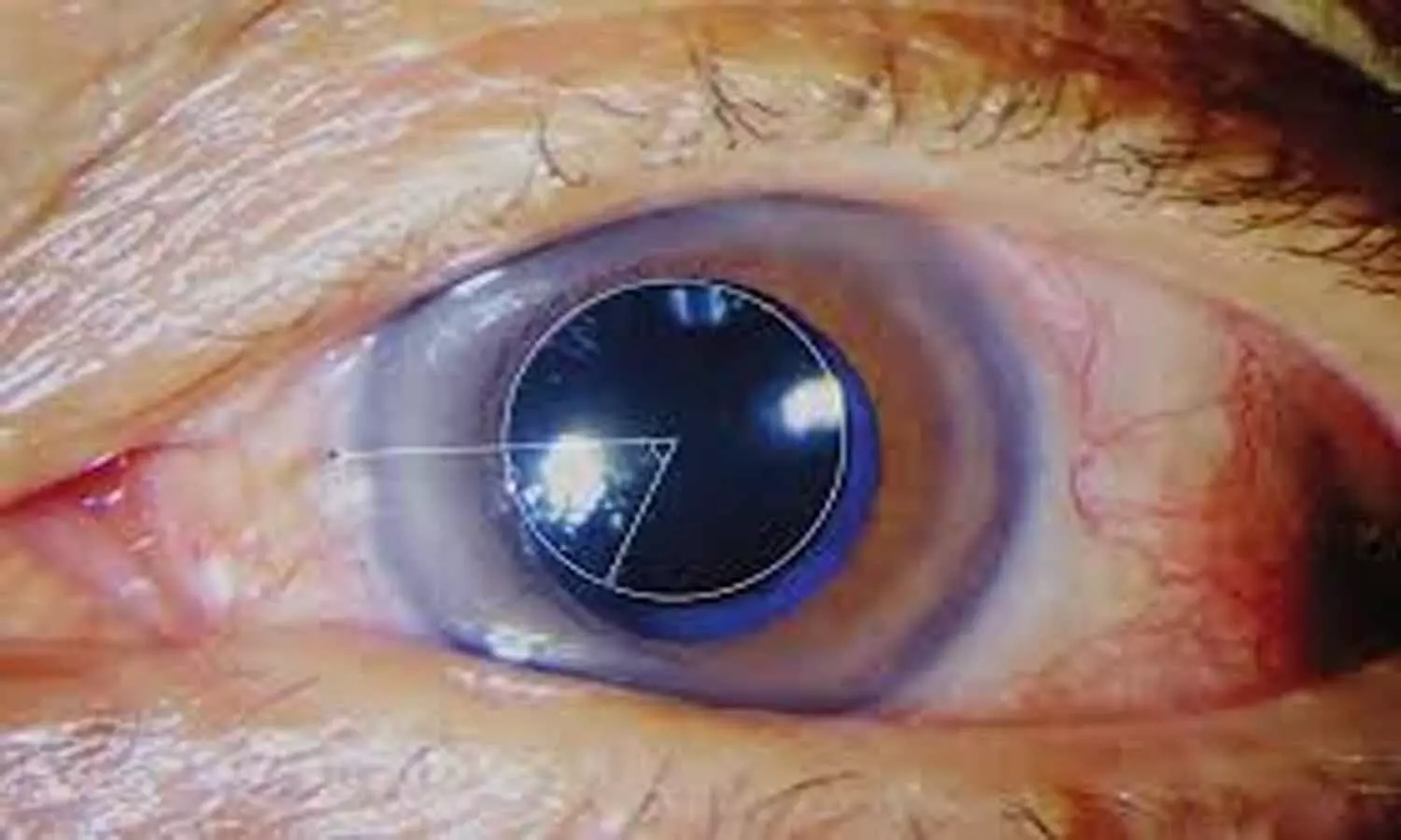A synthetic adhesive liquid hydrogel is new treatment for corneal perforation