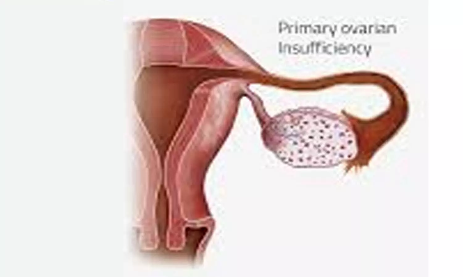 Primary ovarian insufficiency not linked to obesity and diabetes: Study