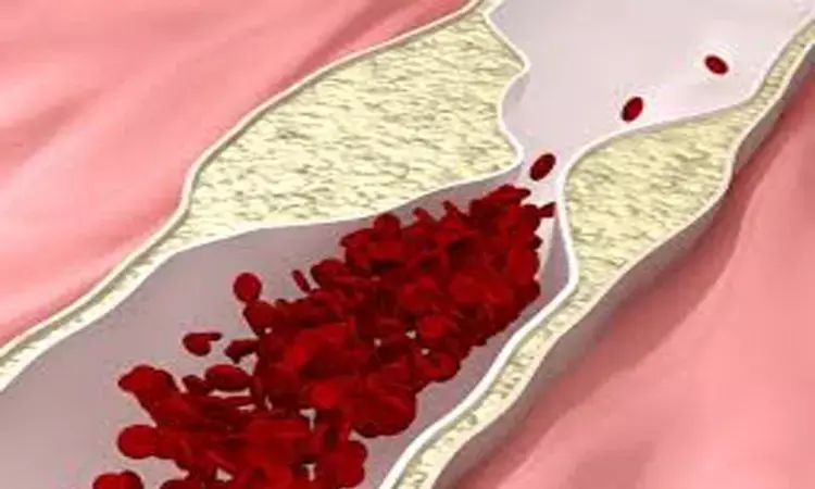 New biomarker may detect atherosclerosis before appearance of symptoms