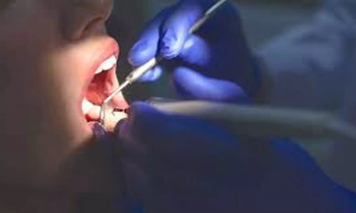 AI helps dentists locate mandibular canals accurately