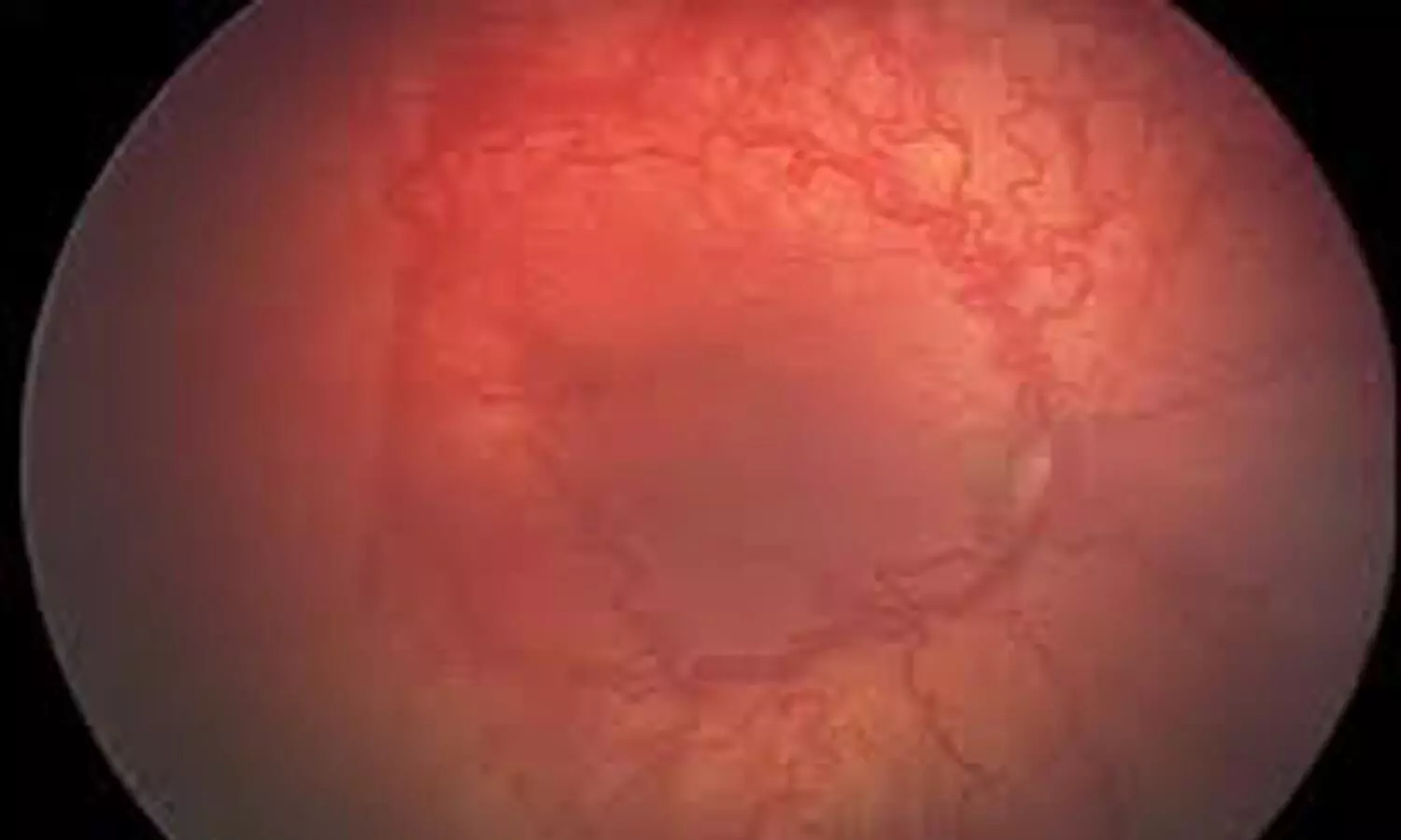 Very low-dose Avastin may help prevent retinopathy of prematurity:JAMA