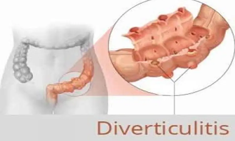 Study supports use of amoxicillin-clavulanate for diverticulitis