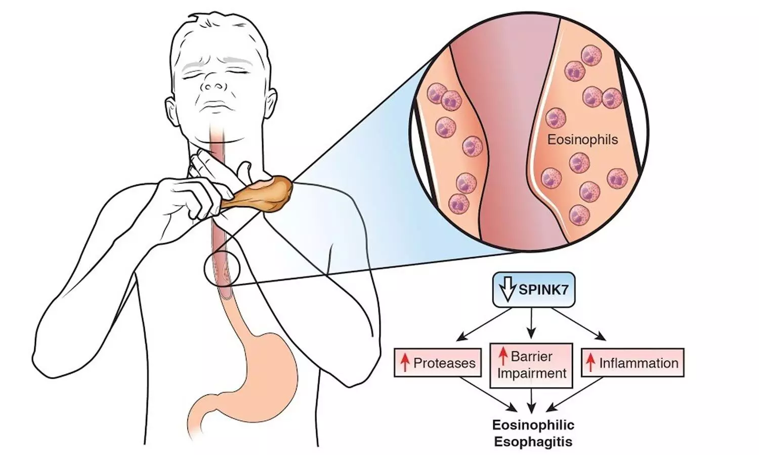 Dieta esofagitis eosinofílica