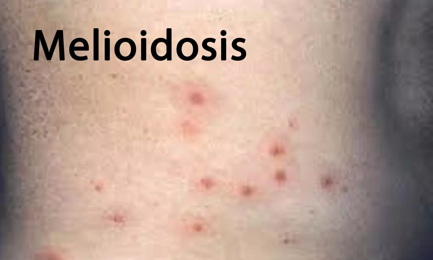 Case of Meliodosis reported in immunocompetent healthy adult in Sri Lanka