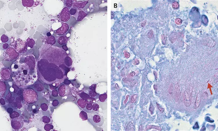 Case of HLH with disseminated tuberculosis reported in NEJM