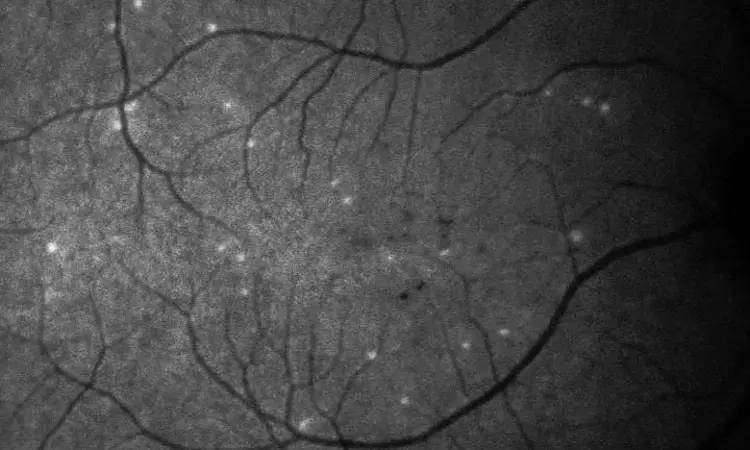 How to manage retinal pigment tear in course of Anti VEGF therapy?