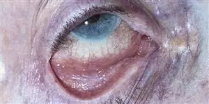 Case study links Covid 19 with follicular conjunctivitis