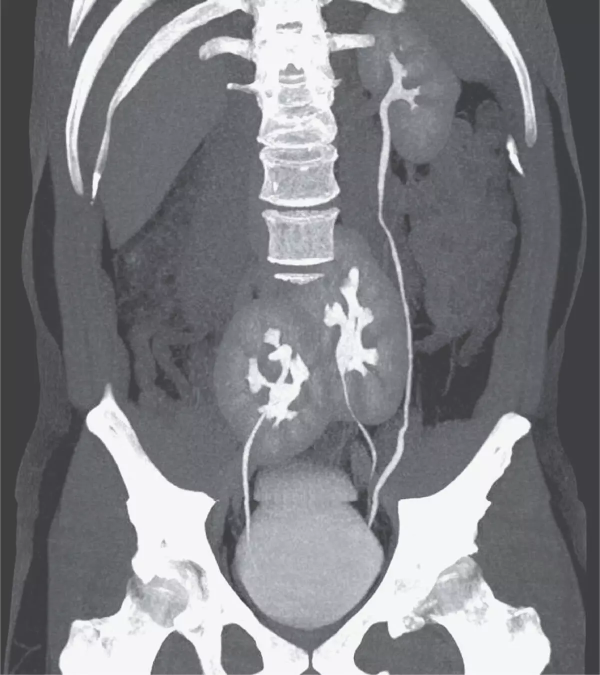 Rare case of three kidneys reported in NEJM