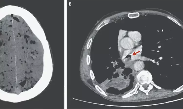 Rare case of Pneumocephalus Due to a Bronchoatrial Fistula reported in NEJM