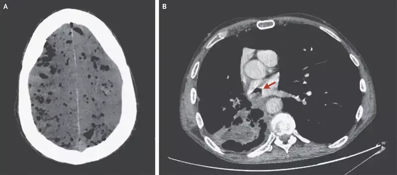 Rare case of Pneumocephalus Due to a Bronchoatrial Fistula reported in NEJM