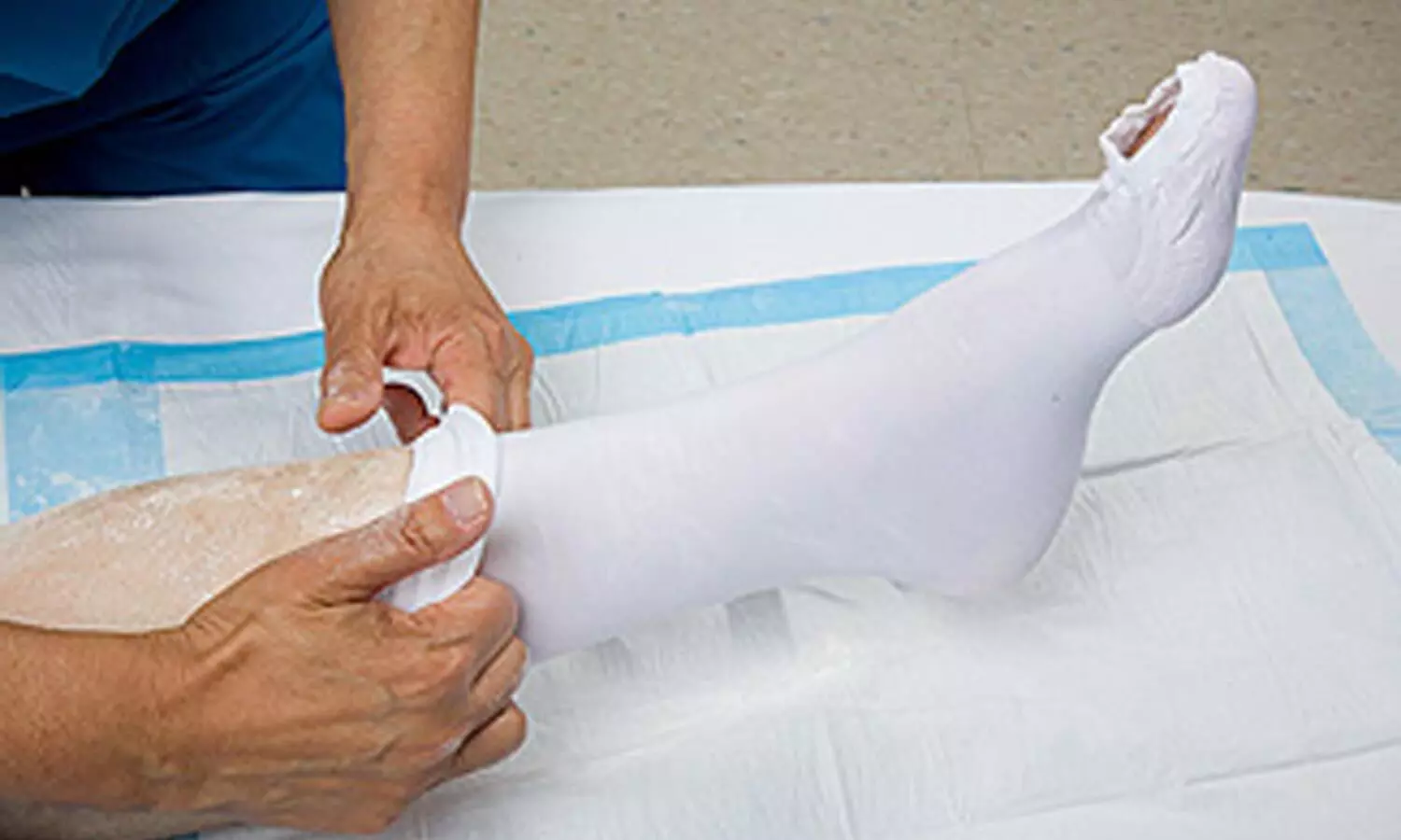 Compression therapy reduces recurrent leg cellulitis, finds NEJM study