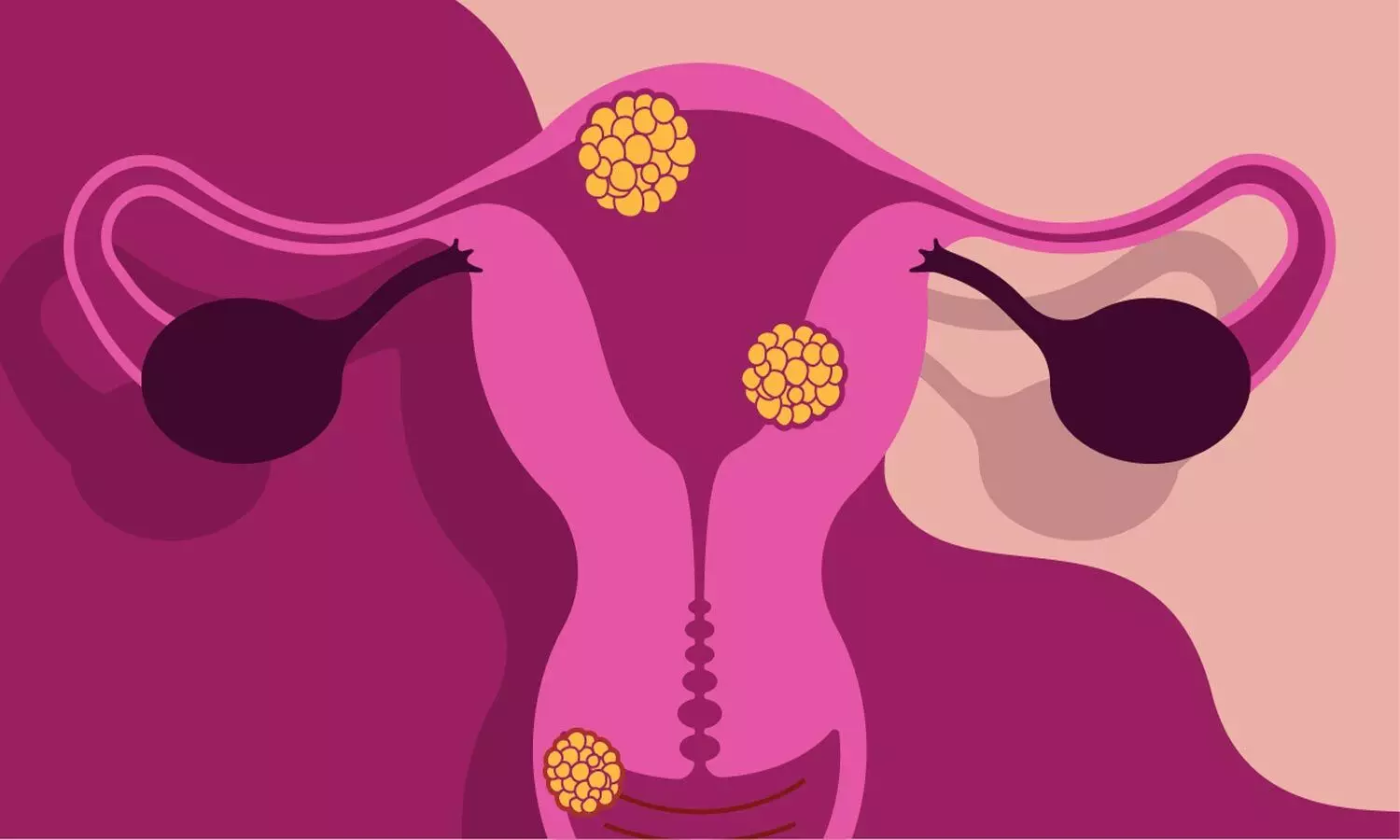 Vaginal health probiotics may help treat bacterial vaginosis