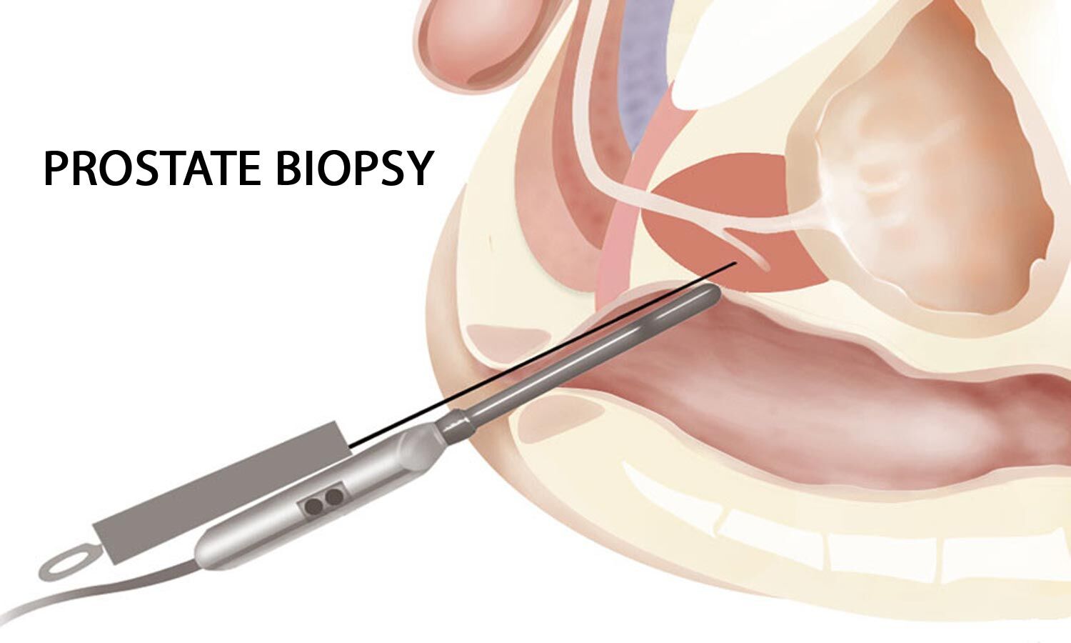 Как берут биопсию у мужчин. Пункционная биопсия предстательной железы.