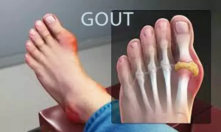 Febuxostat initiation not associated with prolonged acute gout flares: Study